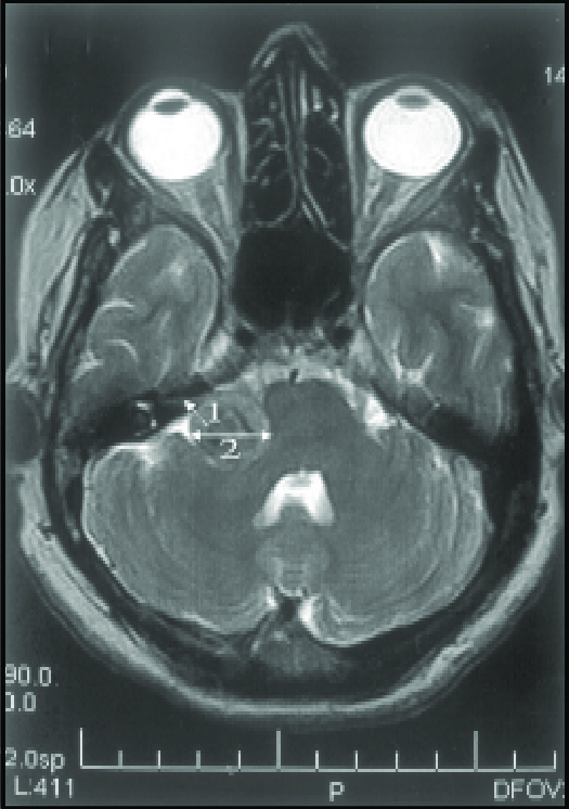 Esta imagem tem um texto alternativo em branco, o nome da imagem é MRI-Showing-intracannalicular-extention-of-Acoustic-neuroma.png